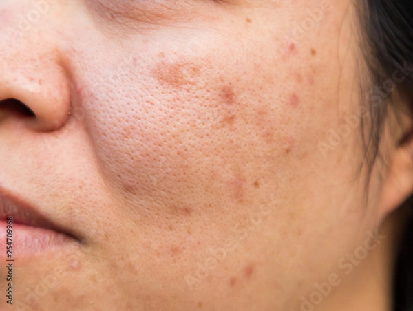 Fototapeta Problems facial skin is acne and blemishes.