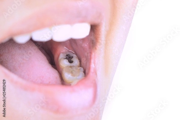 Obraz Oral health, tooth decay due to poor cleaning, treatment of tooth fillings.