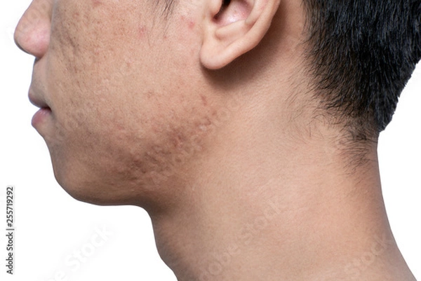 Obraz Close-up acne and scars on asian man face, isolated white background