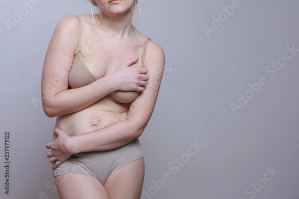 Fototapeta A woman with a figure after giving birth. Stretch marks on the belly. Close the body with his hands. Oppression and shame