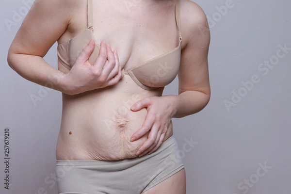 Fototapeta A woman with a figure after giving birth. Stretch marks on the belly. Close the body with his hands. Oppression and shame
