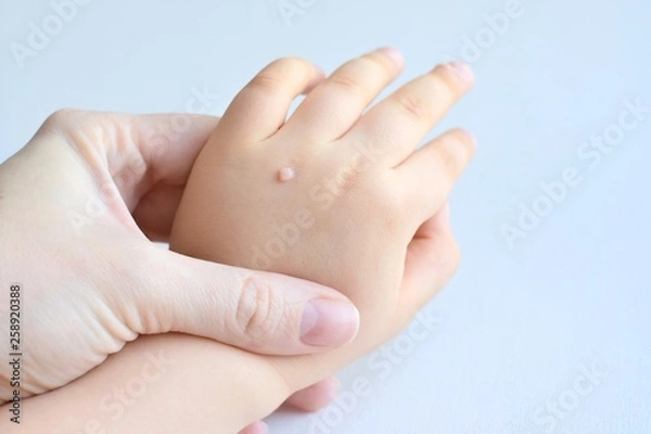 Fototapeta The doctor holds a small hand of a child affected with warts on little fingers and back of the hand. Papillomavirus in a child's hand and fingers. Pediatric dermatology. Skin diseases