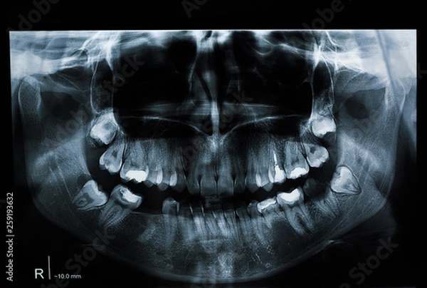 Fototapeta Panoramic dental x-ray of a person with teeth problems. Young female radiography. Missing tooth. Fillings and root canal obturation. 
