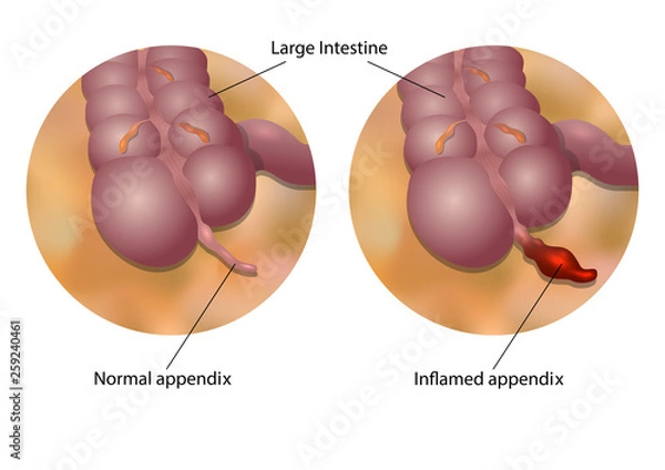 Obraz Formation of appendicitis