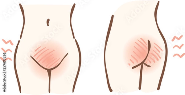 Obraz デリケートゾーン　肌トラブル