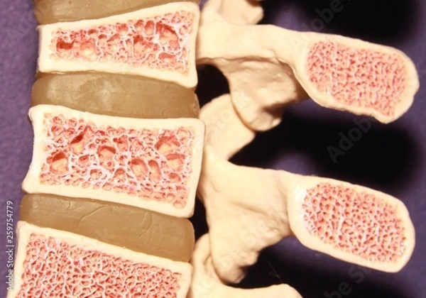 Obraz Model of spine showing porous bone marrow in case of osteoporosis