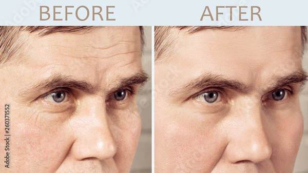 Fototapeta Face of a mature man before and after cosmetic rejuvenating procedures