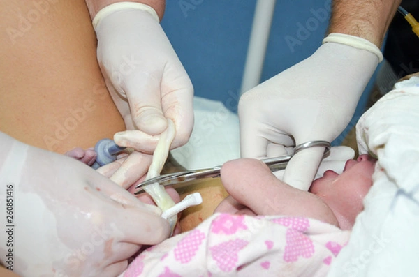 Fototapeta Cutting the umbilical cord between a newborn baby and placenta.