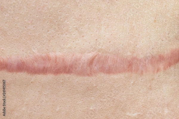 Fototapeta Close up of cyanotic keloid scar caused by surgery and suturing, skin imperfections or defects. Hypertrophic Scar on skin, dermatology and cosmetology concept