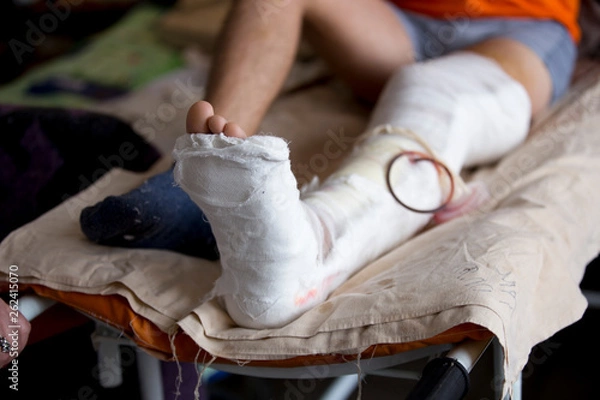 Fototapeta broken leg is fixed and lies on the bed
