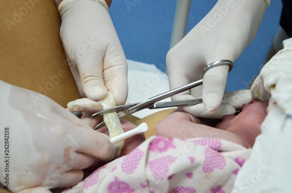 Fototapeta Cutting the umbilical cord between a newborn baby and placenta.