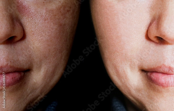 Fototapeta Face with open pores and melasma before and after make up or treatment concept.