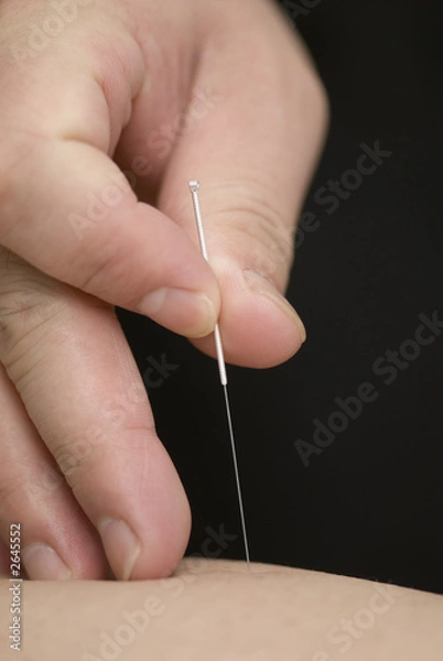 Obraz treatment by acupuncture
