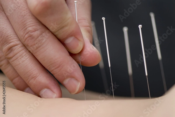 Obraz treatment by acupuncture