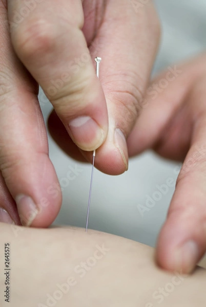 Obraz treatment by acupuncture