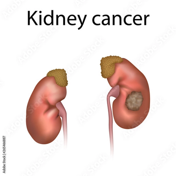 Obraz Kidney cancer. Adrenal glands, ureters, tumor. Realistic anatomy vector illustration.