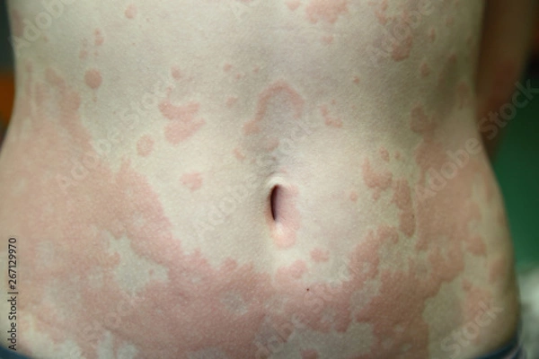 Fototapeta allergic dermatitis
