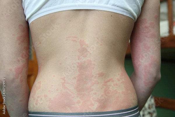Fototapeta allergic dermatitis