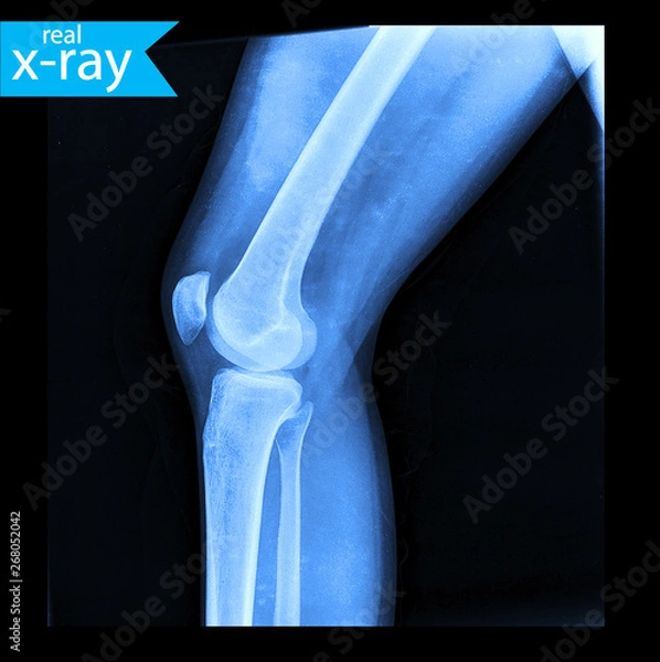 Fototapeta The x-ray of a person's legs. Roentgen of the knee joint. A picture of a skeleton. A real X-ray, medical background. Medicine.