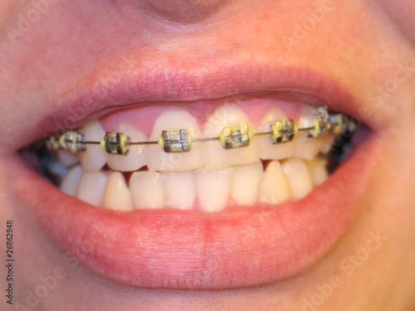 Obraz Mouth with bracket braces
