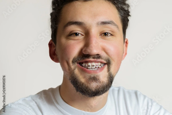 Fototapeta Portrait of a young man with braces smiling. A happy young man with braces on a white background