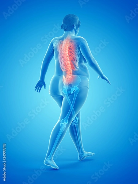 Obraz 3d rendered medically accurate illustration of an obese womans