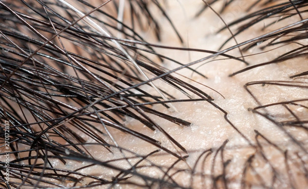 Obraz Macro photography of gray hair and black hair on Scalp.
