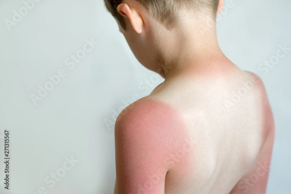 Obraz Strong tan in the boy. Red hands and back. Sore skin, blistered. No sun protection