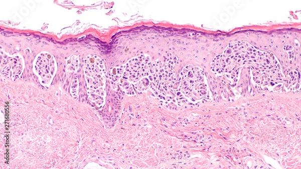 Fototapeta Melanoma in situ (MIS) is an early stage, while tumor cells are still confined to the epidermis, before invasion of dermis.  Excision at this stage is curative.  Use of sunscreen is preventative.  