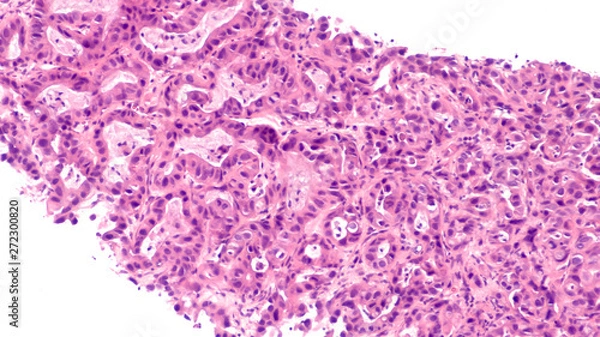 Fototapeta Microscopic image of core biopsy of liver showing metastatic cancer of the pancreas (pancreati