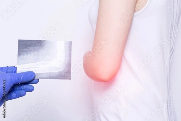 Fototapeta A patient girl who has an elbow ache at a doctor s appointment with a medical bursitis examination of the elbow, close-up