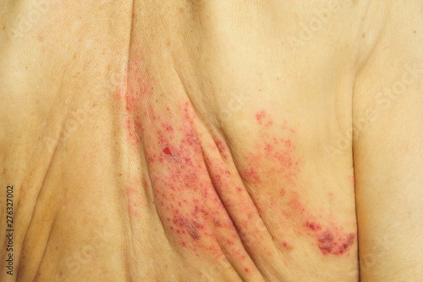Fototapeta Shingles is a viral infection that causes a painful rash
