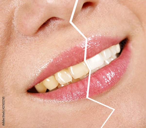 Fototapeta Whitening