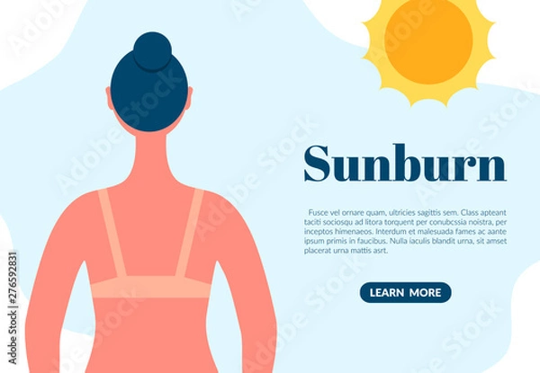 Fototapeta Sunburned woman back view cartoon character. Sun tanning danger concept. Skin redness flat vector illustration