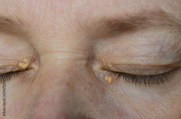 Obraz Close up of woman eyes with Xanthelasma on the eyelids. Hypercholesterolemia, high cholesterol.