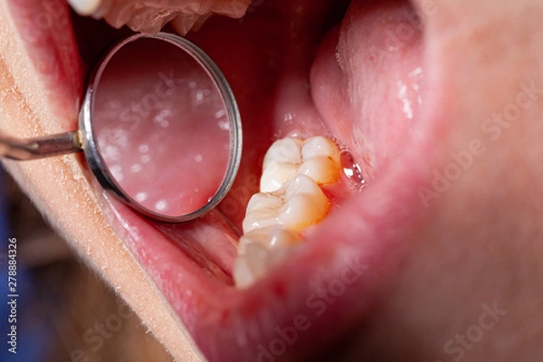 Obraz temporary filling of a tooth caries patient