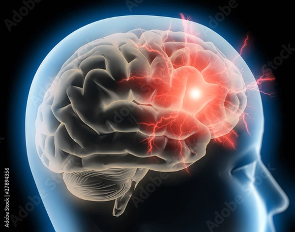 Obraz Ból głowy - migreny