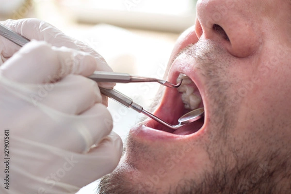 Obraz Kobiece dłonie lekarza stomatologa trzymają lusterko dentystyczne i ekskawator.  Mężczyzna siedzi na fotelu dentystycznym z otwartymi ustami.