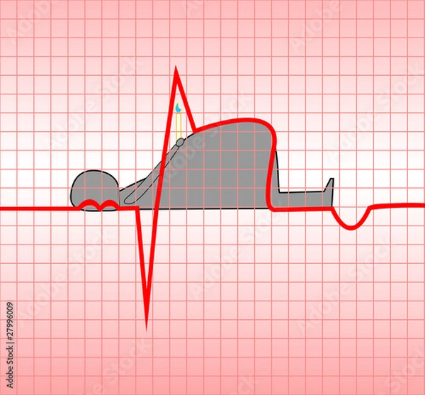 Obraz Myocardial infarction
