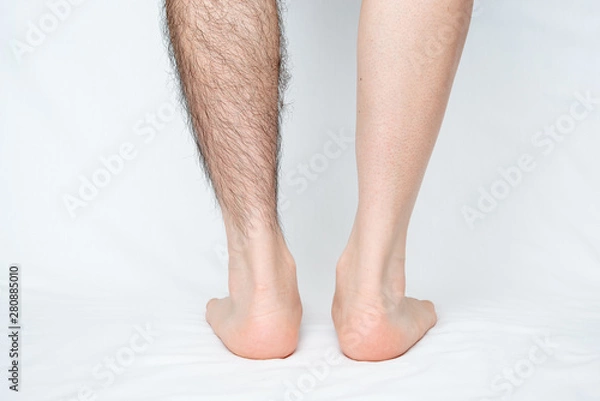 Obraz メンズ　脚脱毛　before & afterイメージ　片脚のみ