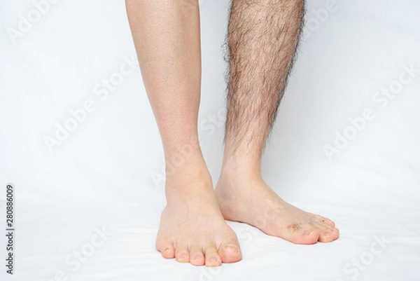 Obraz メンズ　脚脱毛　before & afterイメージ　片脚のみ