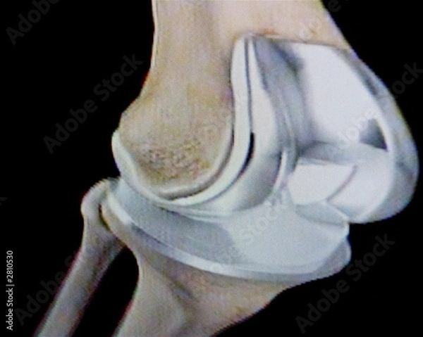 Obraz knee replacements