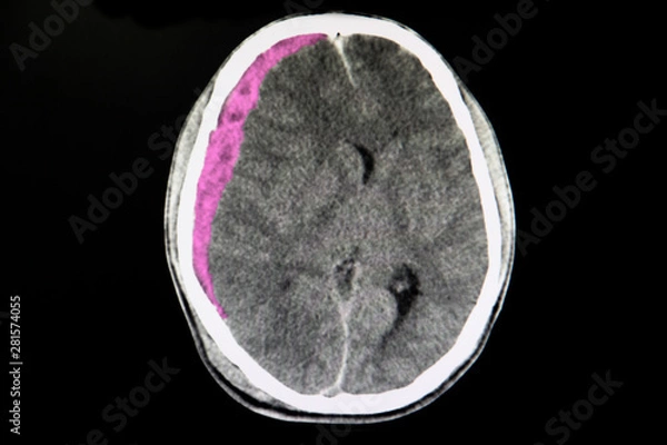 Fototapeta CT brain scan with acute subdural hematoma