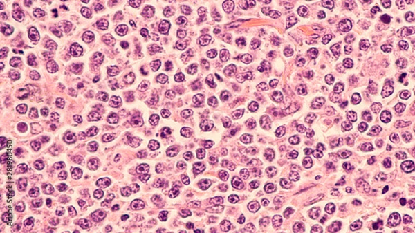 Fototapeta Lymphoma awareness: photomicrograph of a diffuse large B-cell lymphoma (DLBCL) a type of non-Hodgkin lymphoma.  This case is from the testis of an elderly man and shows prominent nucleoli. 