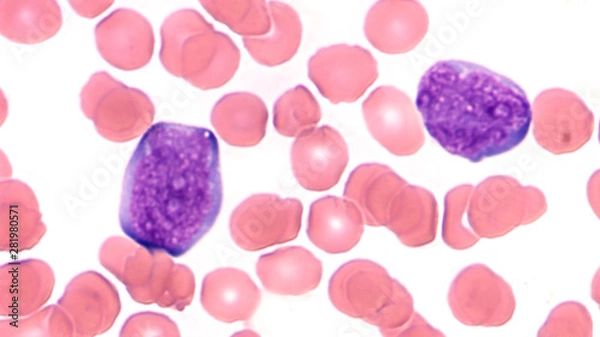 Fototapeta Microscopic image (photomicrograph) of a peripheral blood smear in a patient with acute lymphoblastic leukemia (ALL) showing two  blast cells (lymphoblasts)