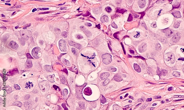 Fototapeta Photomicrograph of a breast cancer (grade 3 invasive ductal carcinoma) with frequent mitoses (mitotic figures), including a large central atypical mitosis.