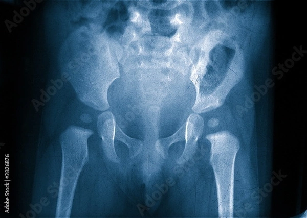 Obraz xray child