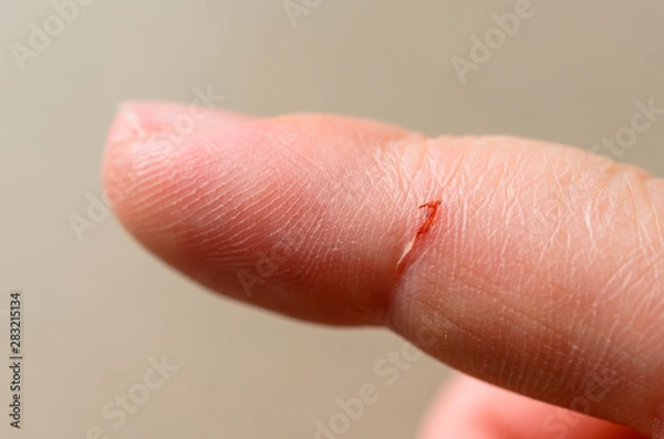 Obraz Open cut wound on the index finger