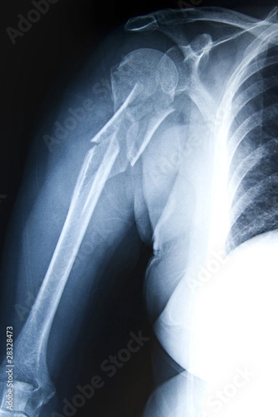 Fototapeta Humerus Fracture - Trauma Xray