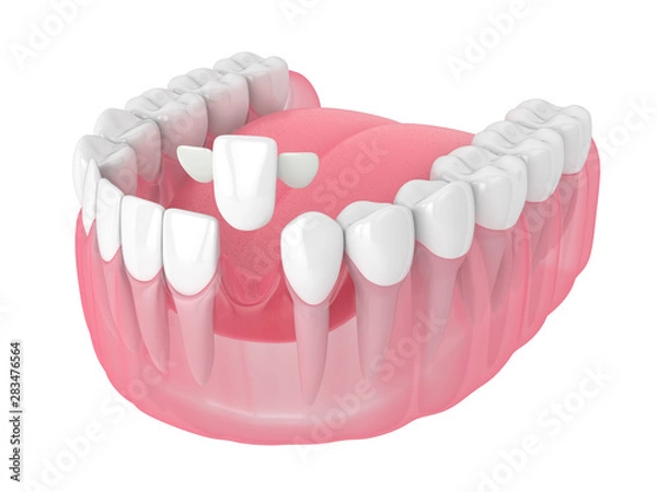Fototapeta 3d render of jaw with teeth and maryland bridge